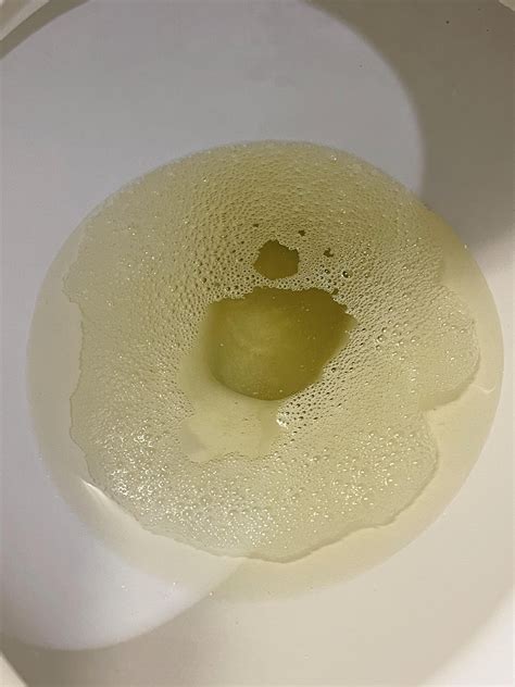 Foamy Urine In Women