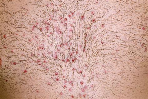 Folliculitis After Waxing