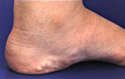 Foot Lump On Arch
