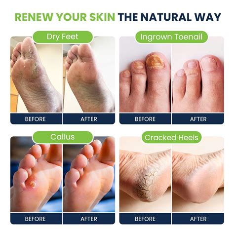 Foot Smell Cure