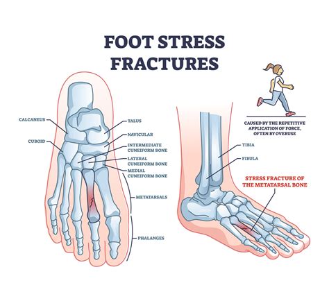 Foot Stress Fracture