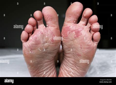 Foot With Dry Skin