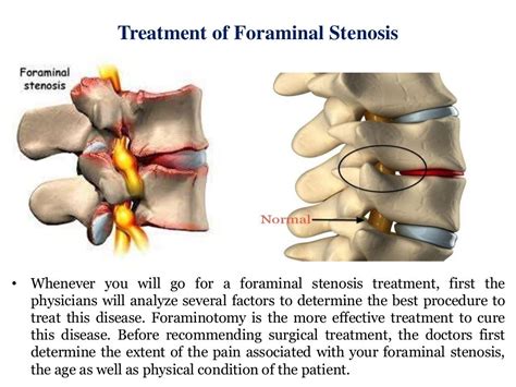 Foraminal Stenosis Treatment
