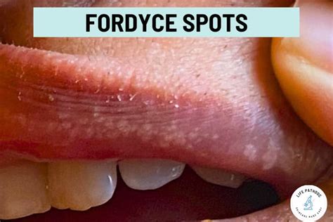 Fordyce Spots On Testicles
