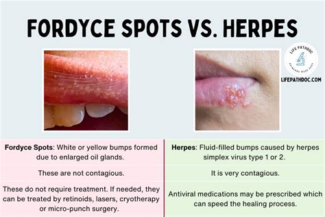 Fordyce Spots Vs Herpes