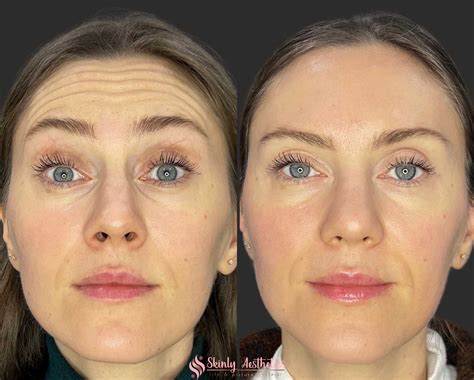 Forehead Lines Botox