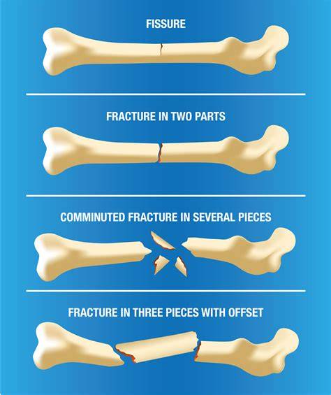 Fracture Broken Bone Difference