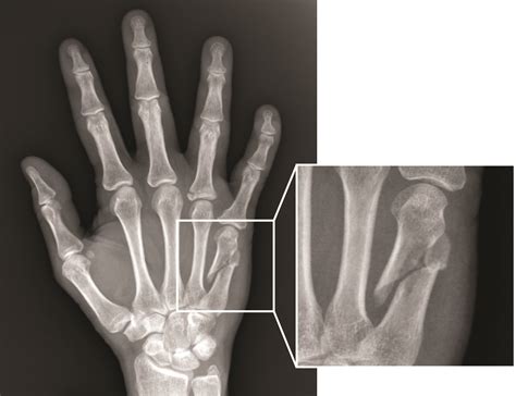 Fracture In Hand