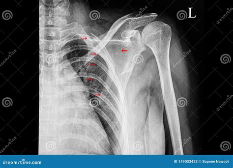 Fracture Of Shoulder Blade