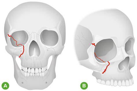 Fracture Orbital Socket