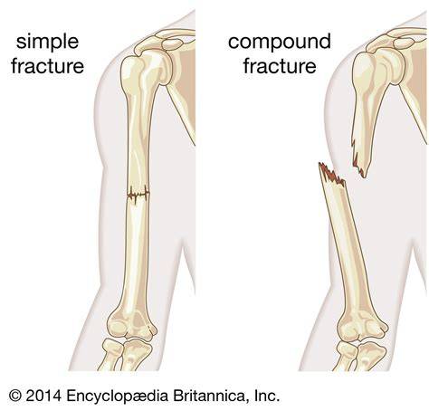 Fracture Vs Broken