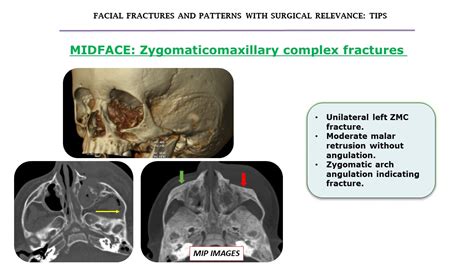 Fracture Zygomaticomaxillary Complex