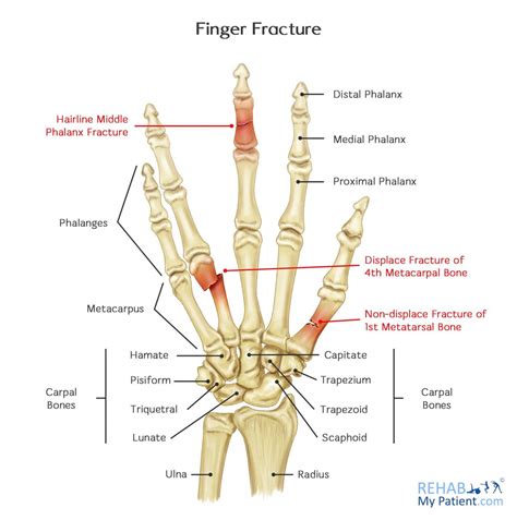 Fractured Finger Recovery Time