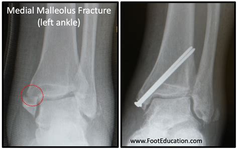 Fractured Medial Malleolus