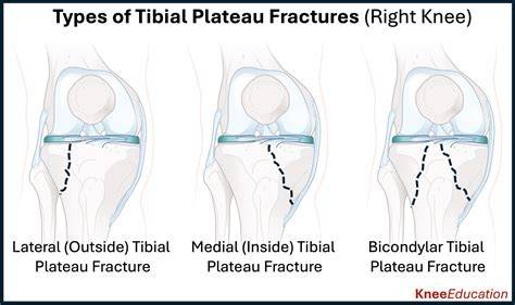 Fractured Tibial Plateau