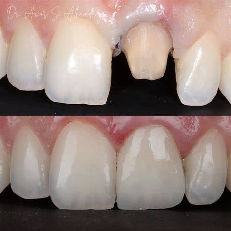 Front Tooth Crown
