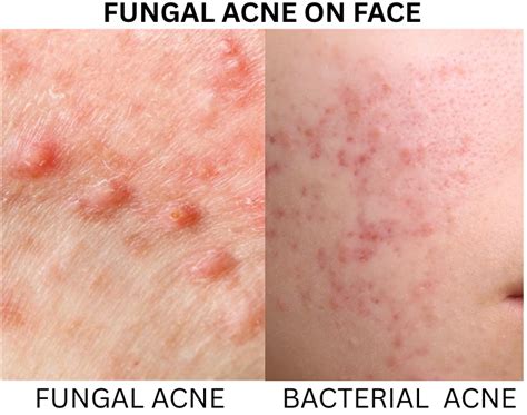 Fungal Acne On Face