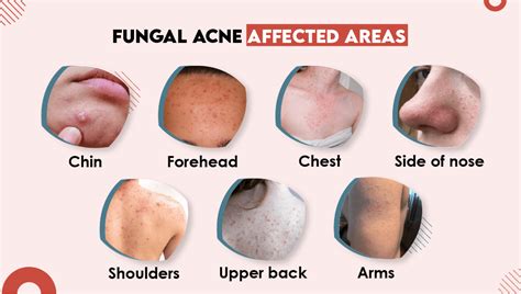 Fungal Acne Treatment