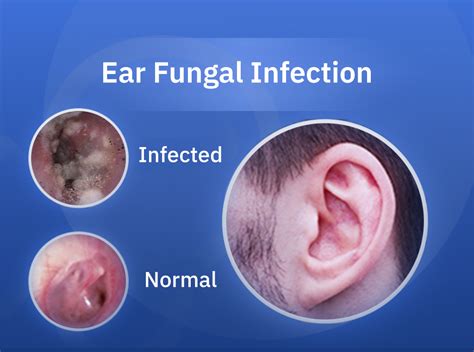 Fungal Ear Infection Otomycosis