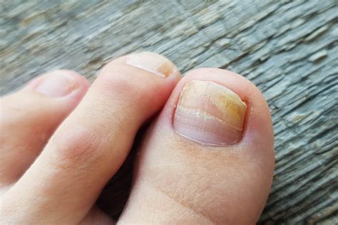 Fungus On Nail Toe