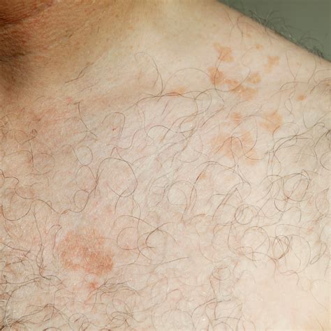 Fungus On Skin