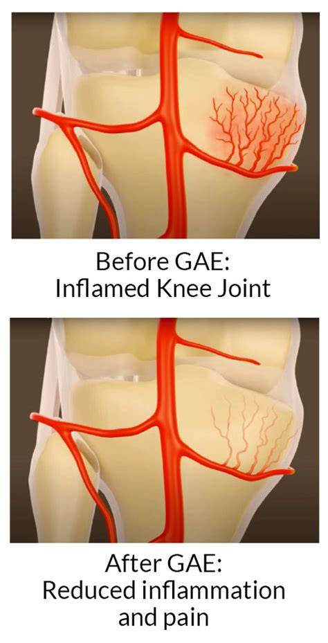 Gae For Knee Pain