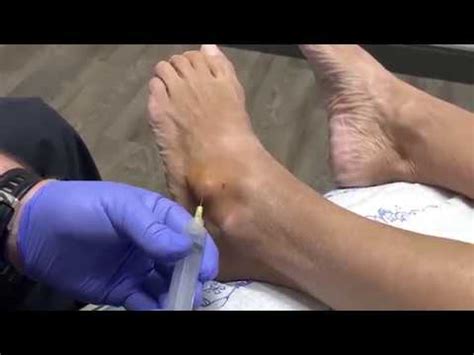Ganglion Cyst Pop