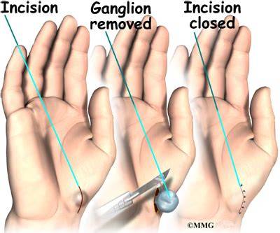 Ganglion Cyst Removal