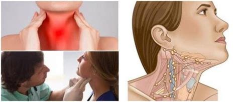 Ganglios Inflamadas Cuello