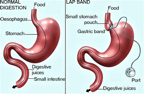 Gastric Band Surgery