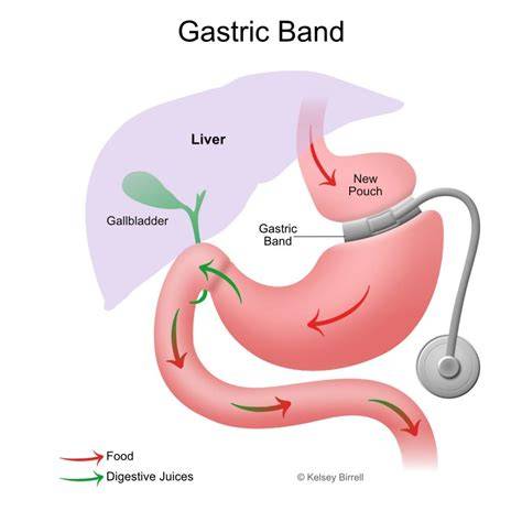 Gastric Band