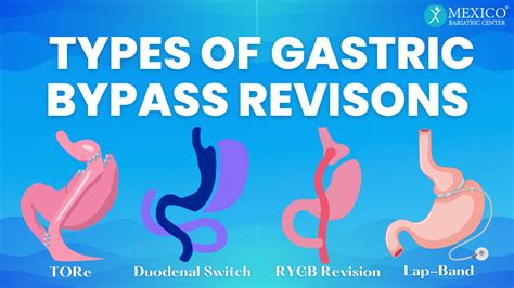 Gastric Bypass Revision