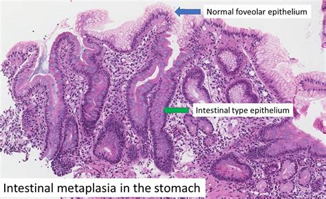 Gastric Intestinal Metaplasia