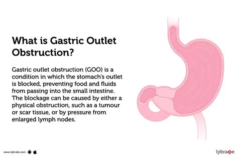 Gastric Outlet Obstruction