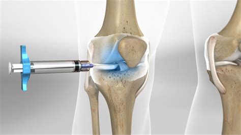 Gel Knee Injections