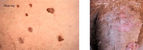 Genital Skin Tags