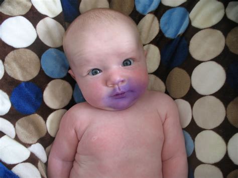 Gentian Violet For Thrush