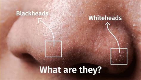 Get Rid Of Whiteheads