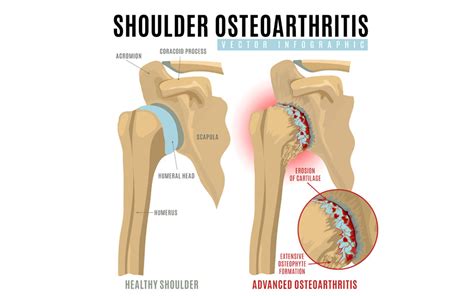 Glenohumeral Shoulder Joint Arthritis