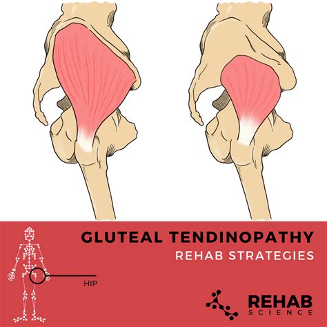 Gluteus Medius Tendinopathy