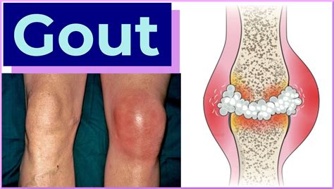 Gout In Knee Symptoms