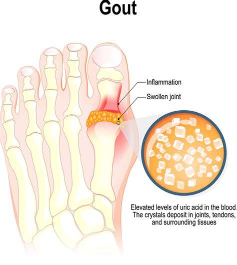 Gout In Spanish