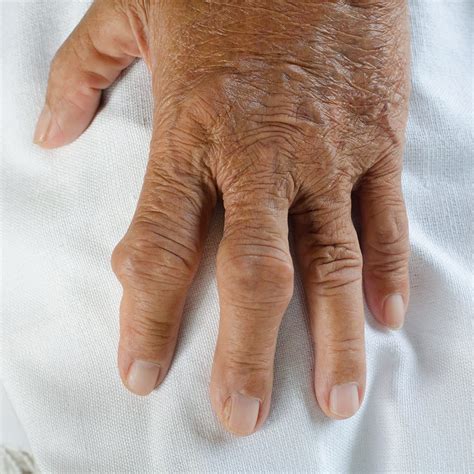 Gout In The Hand