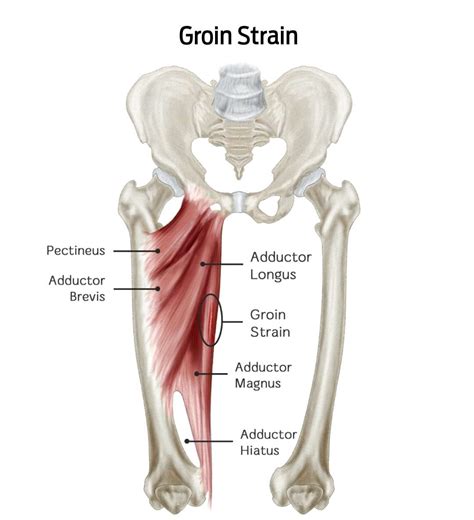 Groin Tear Symptoms
