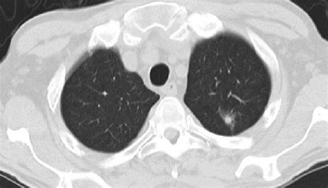Ground Glass Nodule In Lung
