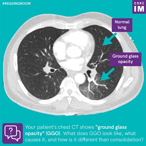 Ground Glass Opacity In Lungs