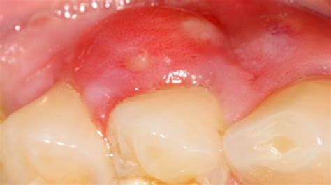 Gum Abscess Pop