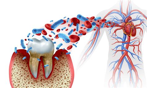 Gum Disease Selfcare