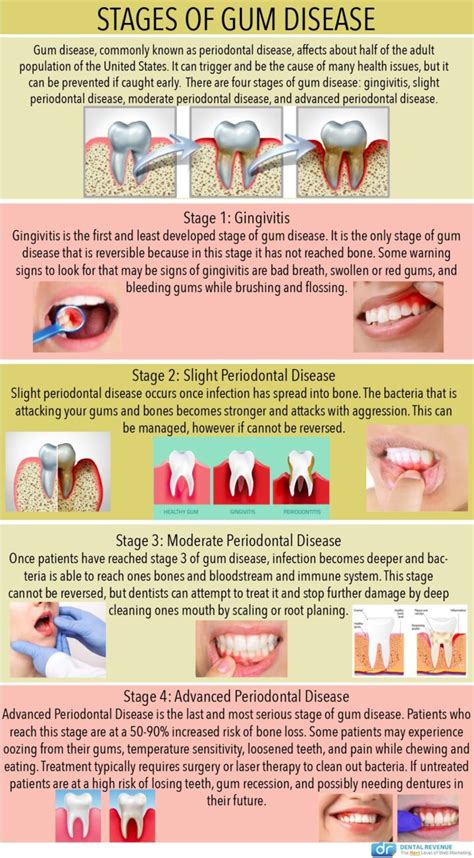 Gum Infection And Treatment