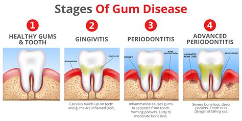 Gum Inflammation Treatment
